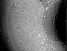 Degenerative Spondylolisthese