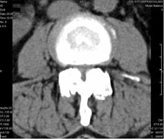Lumbale Spinalkanalstenose