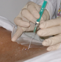 Periradikuläre Therapie, PRT