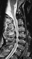 Zervikale <br>Spinalkanalstenose
