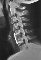 Zervikale Stabilisierungsoperation